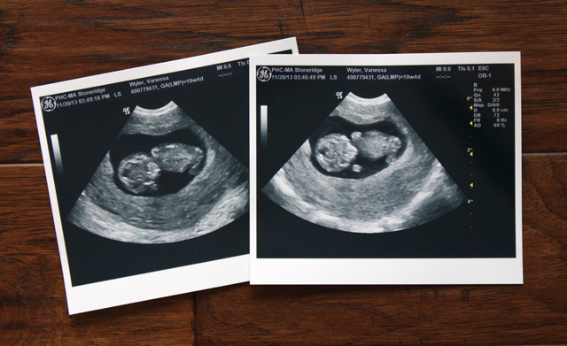 ultrasound 10 weeks